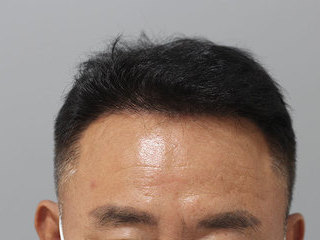 모발이식 전 / 수술 후 8개월 경과