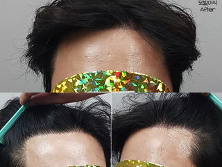 30대 남성 M자 비절개 모발이식 3600모 12개월 경과