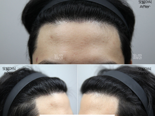 20대 남성 헤어라인~구레나룻 모발이식 2400모 1년 경과