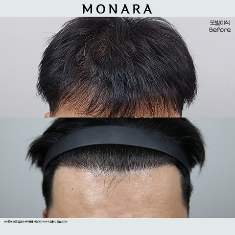 40대 남성 이마+ 정수리 모발이식 5000모 8개월 경과