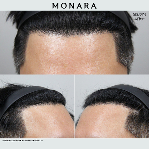 40대 남성 M자 탈모 모발이식 3000모 8개월 경과