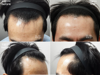 30대 남성 M자 탈모 모발이식 3,000모 18개월 경과