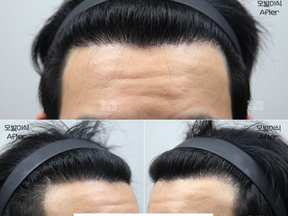 20대 남성 m자탈모 모발이식 3,000모 8개월 경과 