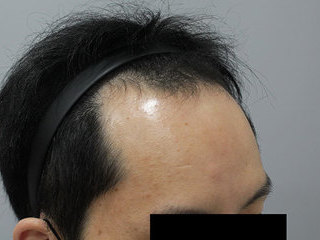 모발이식 전 / 수술 후 경과