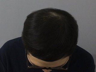 두피문신 정수리 시술 전 / 후
