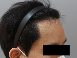 모발이식 전 / 수술 후 경과