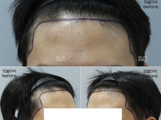 20대 남성 헤어라인~구레나룻 모발이식 2400모 1년 경과